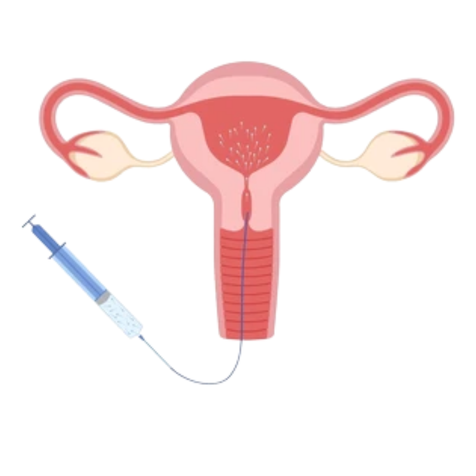 Inseminação Intrauterina (IIU)